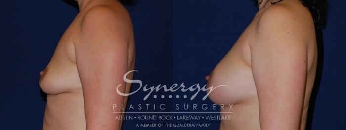 Before & After Breast Augmentation Case 121 View #5 View in Austin, TX