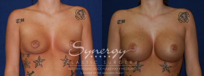 Before & After Breast Augmentation Case 124 View #1 View in Austin, TX