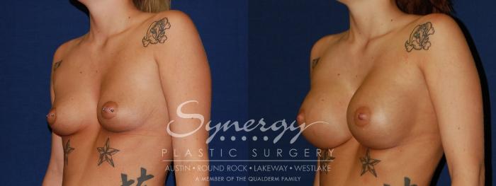 Before & After Breast Augmentation Case 124 View #3 View in Austin, TX