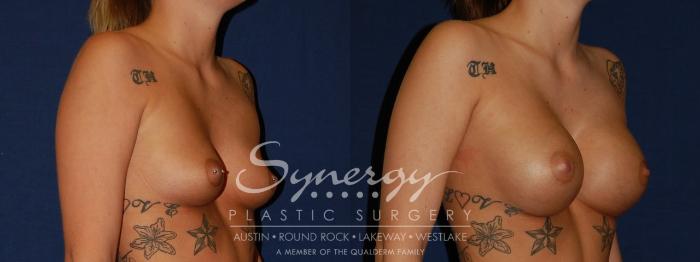 Before & After Breast Augmentation Case 124 View #4 View in Austin, TX