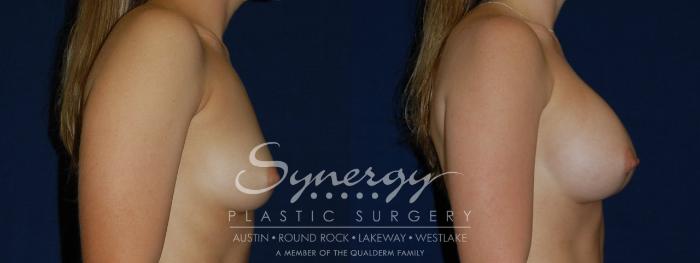 Before & After Breast Augmentation Case 135 View #5 View in Austin, TX