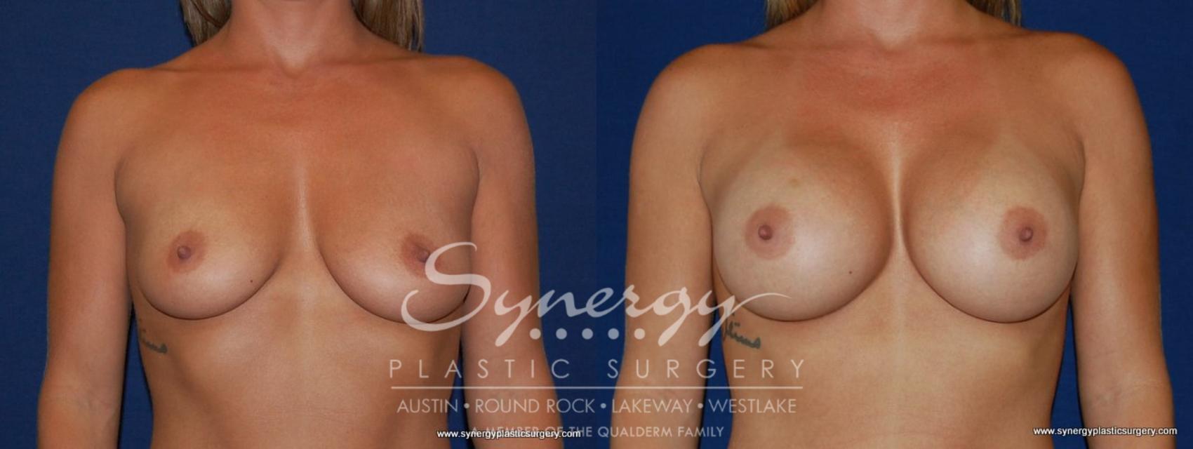 Before & After Breast Augmentation Case 141 View #1 View in Austin, TX