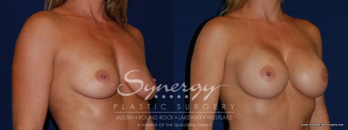 Before & After Breast Augmentation Case 141 View #2 View in Austin, TX