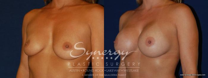 Before & After Breast Augmentation Case 141 View #3 View in Austin, TX