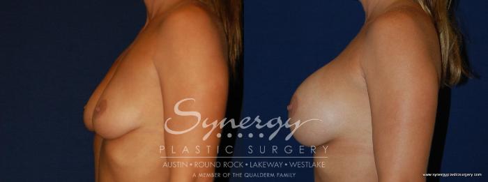 Before & After Breast Augmentation Case 141 View #4 View in Austin, TX