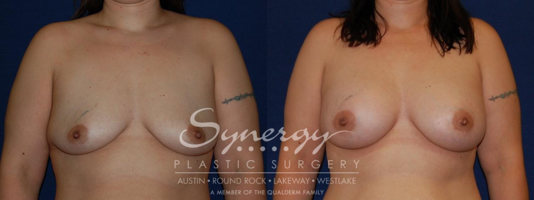 Before & After Breast Augmentation Case 142 View #1 View in Austin, TX