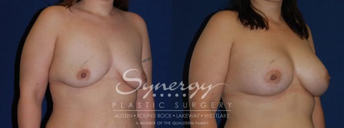 Before & After Breast Augmentation Case 142 View #2 View in Austin, TX