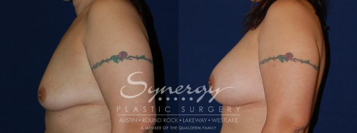 Before & After Breast Augmentation Case 142 View #4 View in Austin, TX