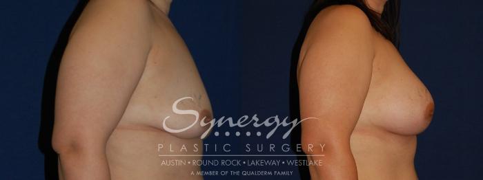 Before & After Breast Augmentation Case 142 View #5 View in Austin, TX