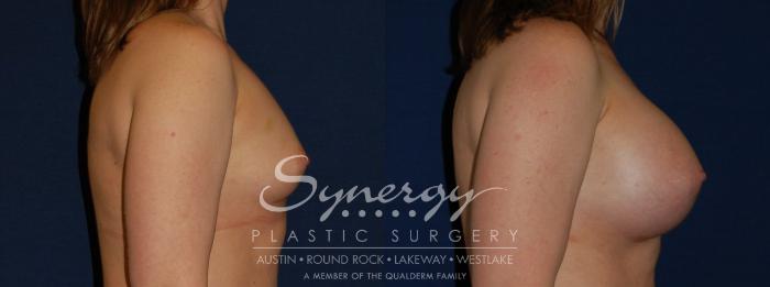 Before & After Breast Augmentation Case 143 View #2 View in Austin, TX