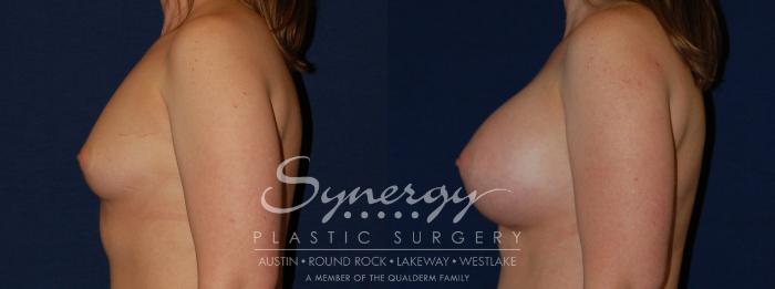 Before & After Breast Augmentation Case 143 View #4 View in Austin, TX