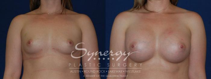 Before & After Breast Augmentation Case 143 View #5 View in Austin, TX