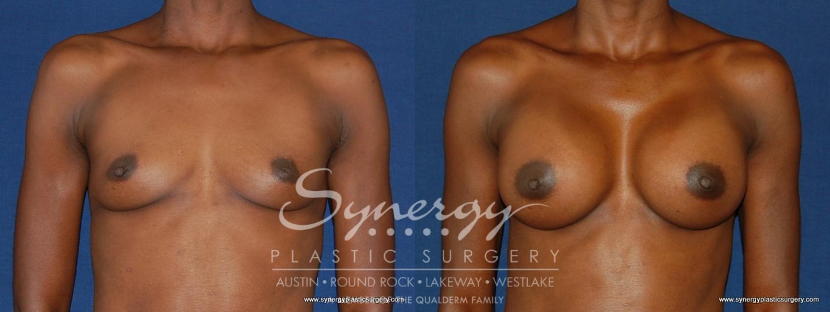 Before & After Breast Augmentation Case 165 View #1 View in Austin, TX