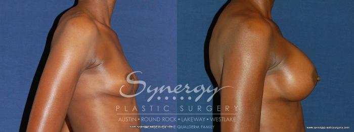 Before & After Breast Augmentation Case 165 View #2 View in Austin, TX
