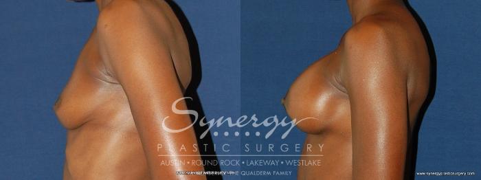 Before & After Breast Augmentation Case 165 View #4 View in Austin, TX