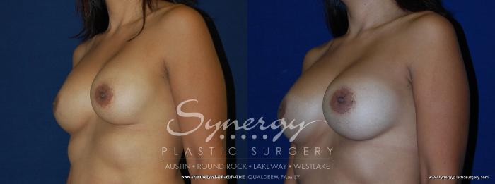 Before & After Breast Augmentation Case 166 View #3 View in Austin, TX