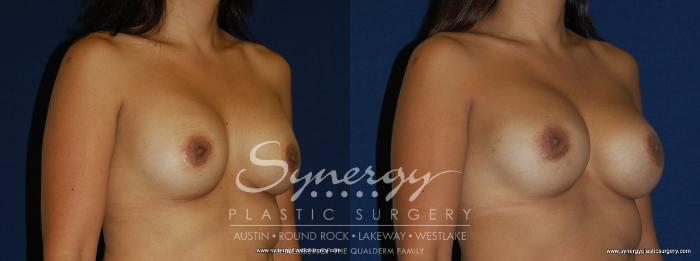 Before & After Breast Augmentation Case 166 View #5 View in Austin, TX