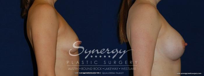 Before & After Breast Augmentation Case 170 View #4 View in Austin, TX