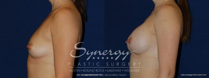 Before & After Breast Augmentation Case 170 View #5 View in Austin, TX