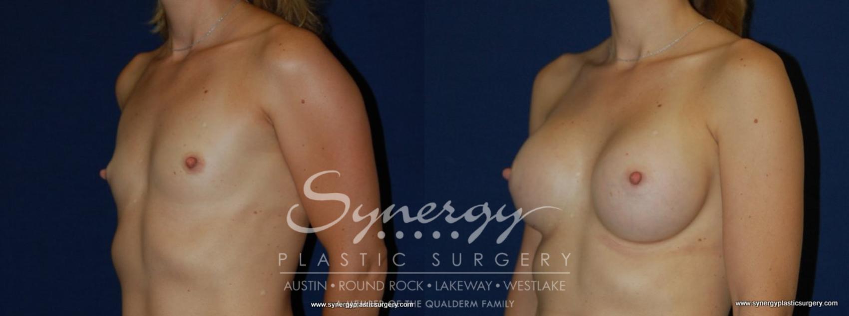 Before & After Breast Augmentation Case 171 View #1 View in Austin, TX