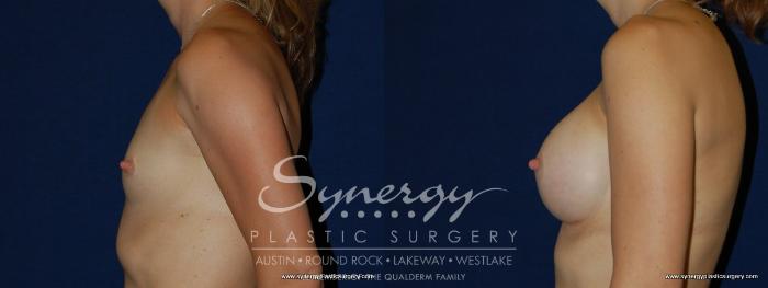 Before & After Breast Augmentation Case 171 View #3 View in Austin, TX