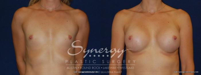 Before & After Breast Augmentation Case 171 View #4 View in Austin, TX