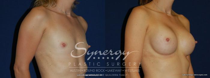 Before & After Breast Augmentation Case 171 View #5 View in Austin, TX