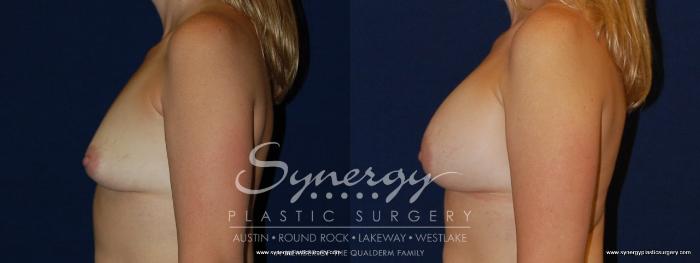 Before & After Breast Augmentation Case 181 View #2 View in Austin, TX