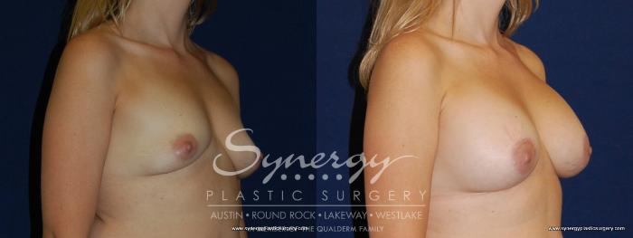 Before & After Breast Augmentation Case 181 View #4 View in Austin, TX
