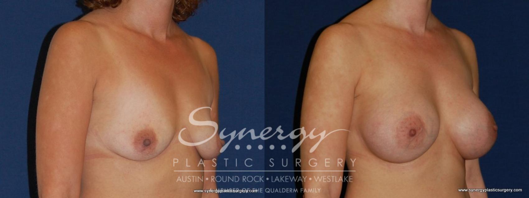 Before & After Breast Augmentation Case 187 View #1 View in Austin, TX
