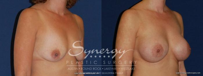 Before & After Breast Augmentation Case 187 View #1 View in Austin, TX