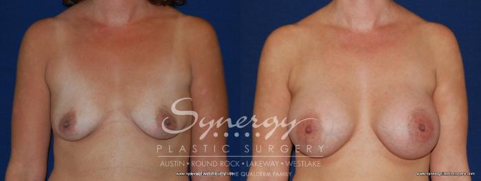 Before & After Breast Augmentation Case 187 View #3 View in Austin, TX