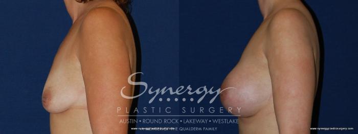 Before & After Breast Augmentation Case 187 View #4 View in Austin, TX