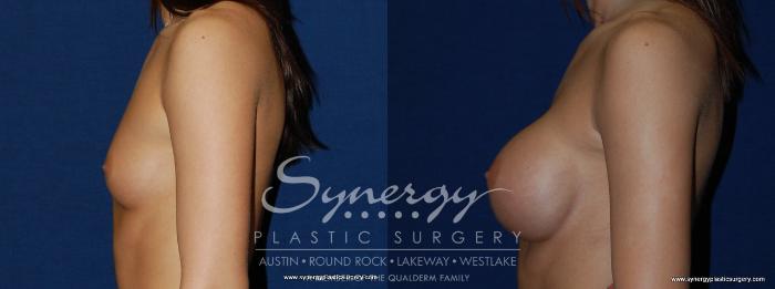 Before & After Breast Augmentation Case 197 View #2 View in Austin, TX