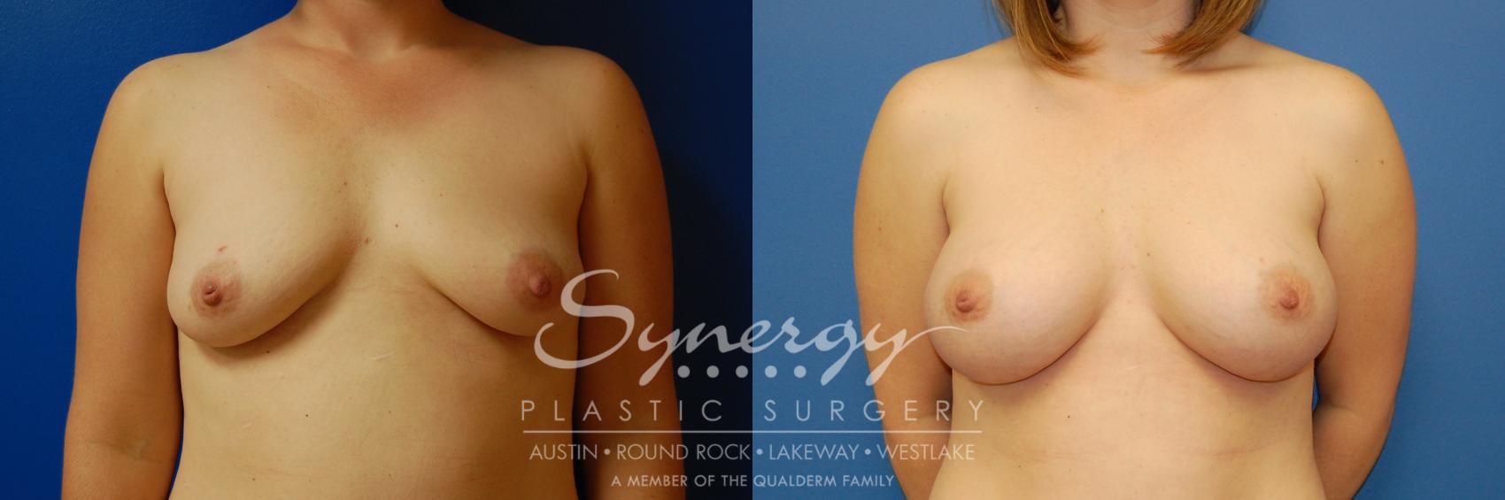 Before & After Breast Augmentation Case 2 View #1 View in Austin, TX
