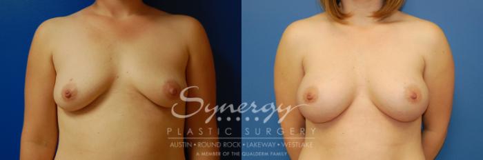 Before & After Breast Augmentation Case 2 View #1 View in Austin, TX