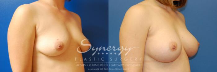 Before & After Breast Augmentation Case 2 View #2 View in Austin, TX