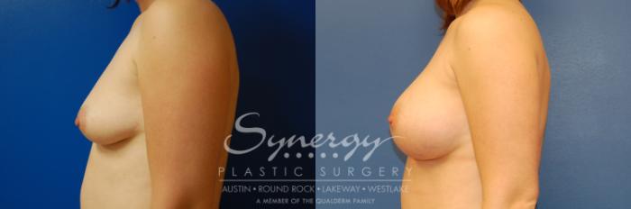 Before & After Breast Augmentation Case 2 View #5 View in Austin, TX