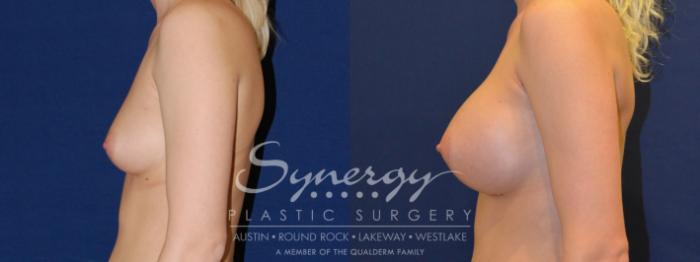 Before & After Breast Augmentation Case 204 View #4 View in Austin, TX