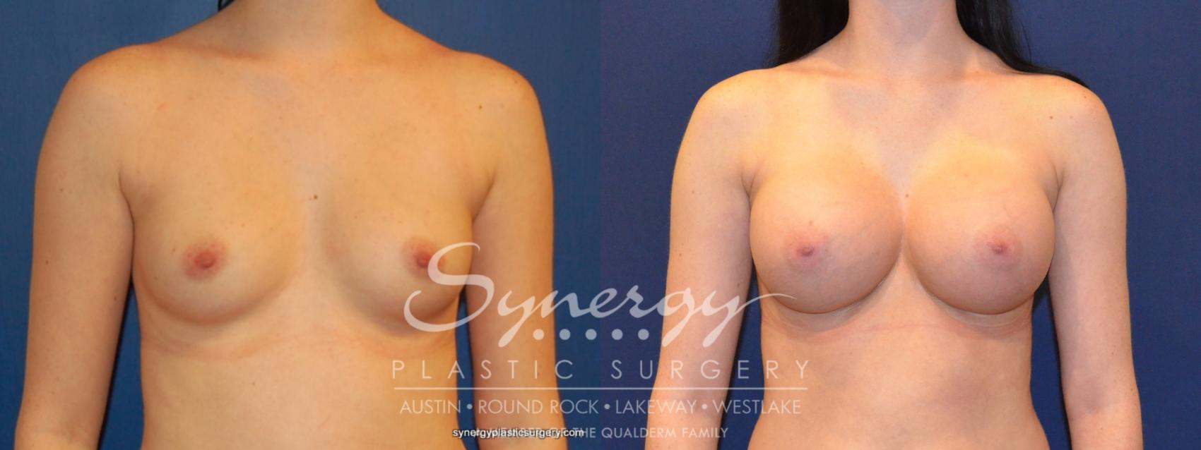 Before & After  Case 207 View #1 View in Austin, TX