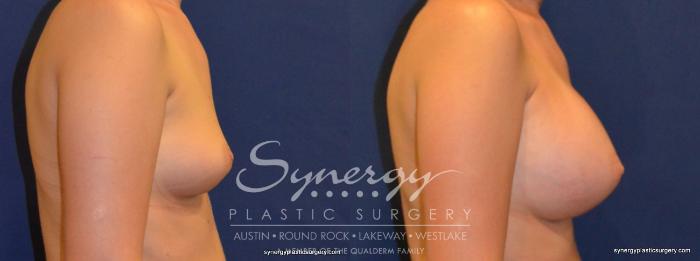 Before & After Breast Augmentation Case 211 View #2 View in Austin, TX