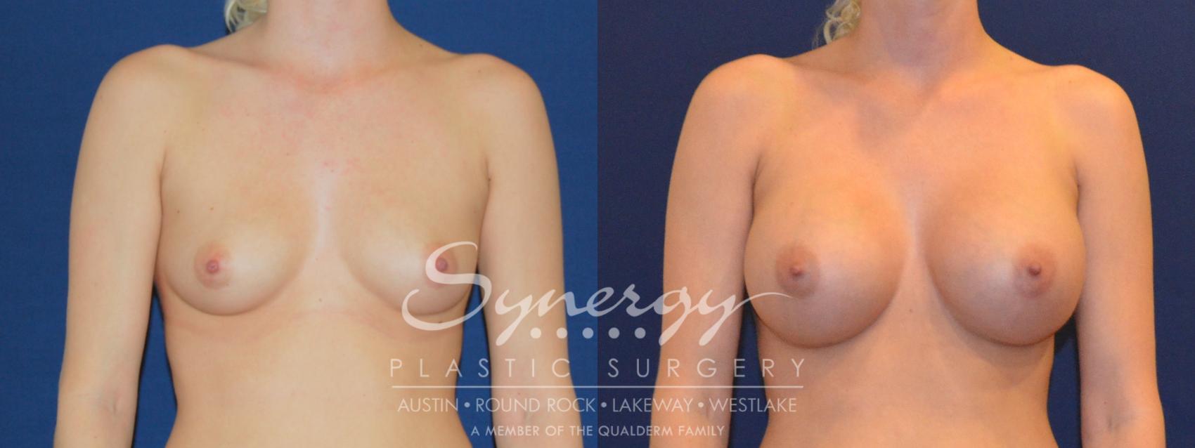 Before & After Breast Augmentation Case 212 View #1 View in Austin, TX