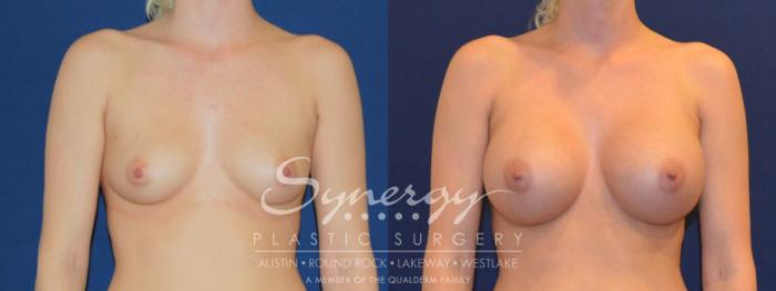 Before & After Breast Augmentation Case 212 View #1 View in Austin, TX