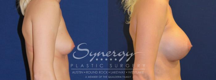 Before & After Breast Augmentation Case 212 View #2 View in Austin, TX