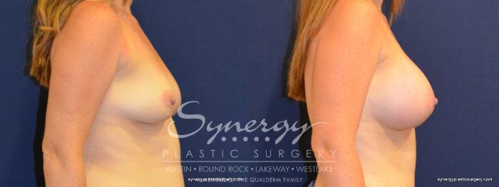 Before & After Breast Augmentation Case 215 View #2 View in Austin, TX