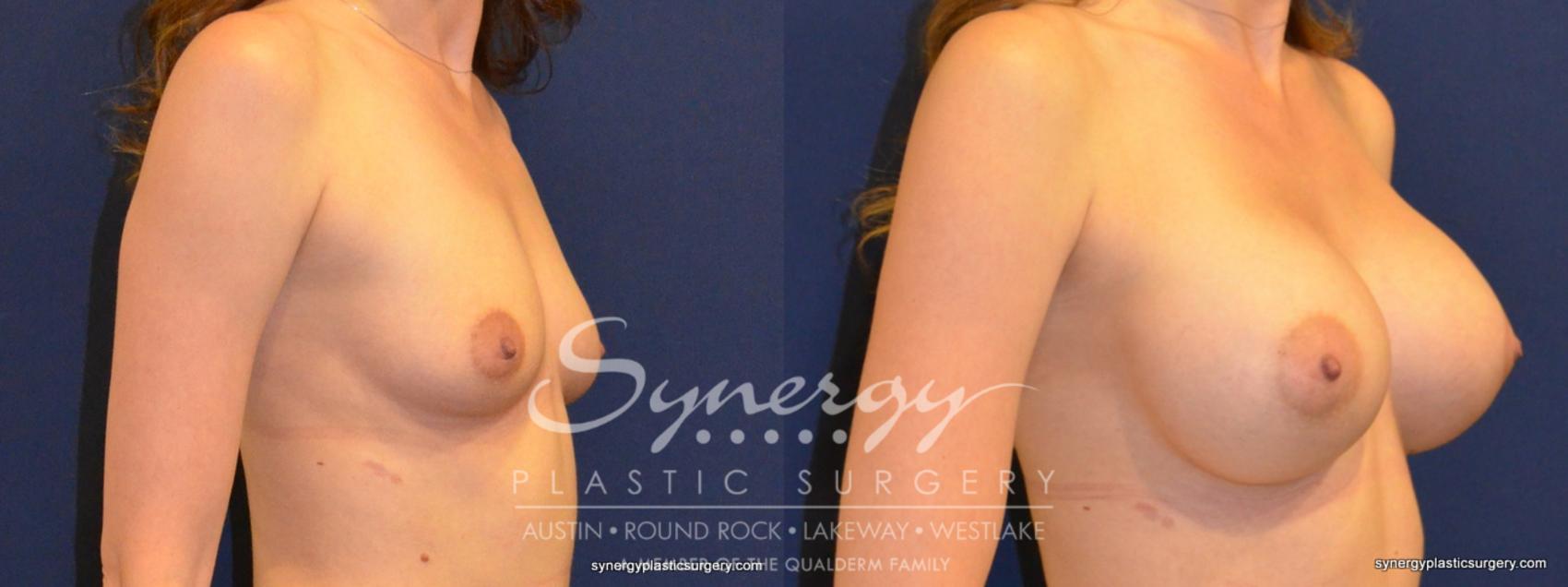 Before & After Breast Augmentation Case 218 View #1 View in Austin, TX