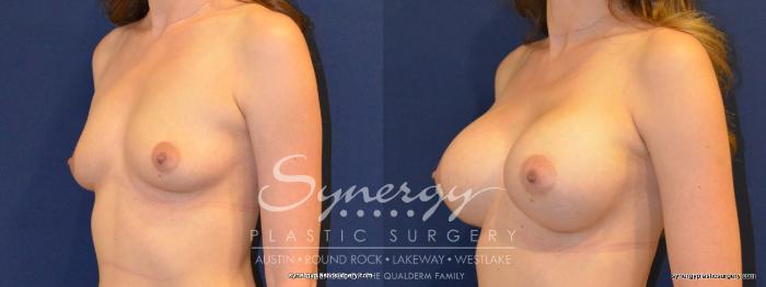 Before & After Breast Augmentation Case 218 View #4 View in Austin, TX