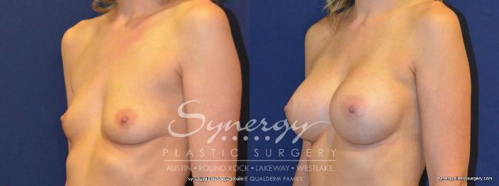 Before & After Breast Augmentation Case 220 View #2 View in Austin, TX