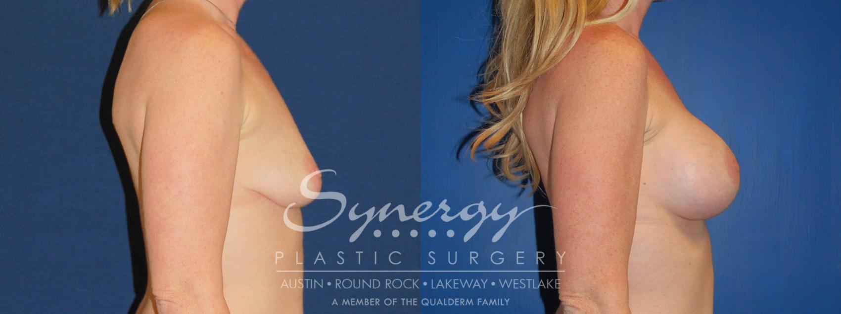 Before & After Breast Augmentation Case 221 View #1 View in Austin, TX