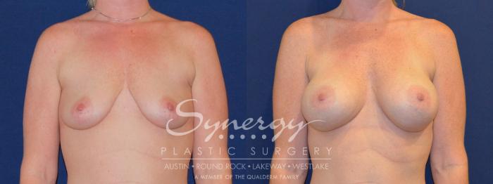Before & After Breast Augmentation Case 221 View #2 View in Austin, TX